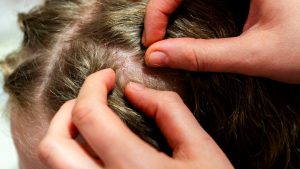 Parent carefully checking a child's hair close to the scalp for nits, the decision moment when families try to tell live nits from dead nit shells after lice treatment