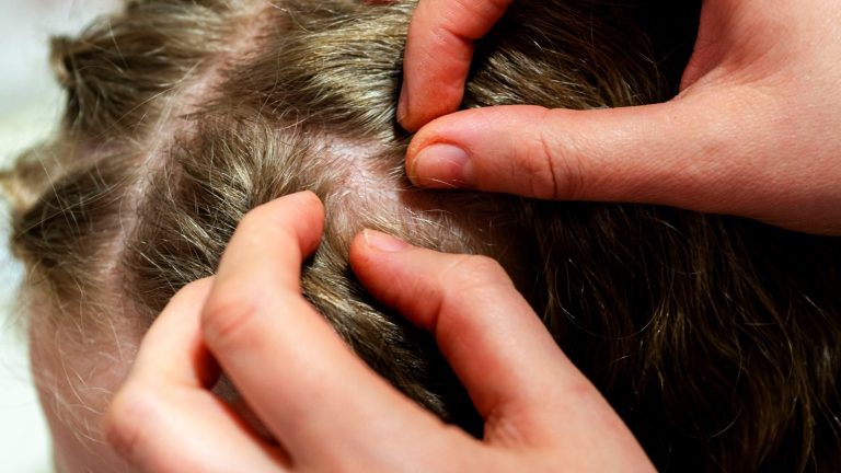 How Can You Tell If Nits Are Dead or Alive?