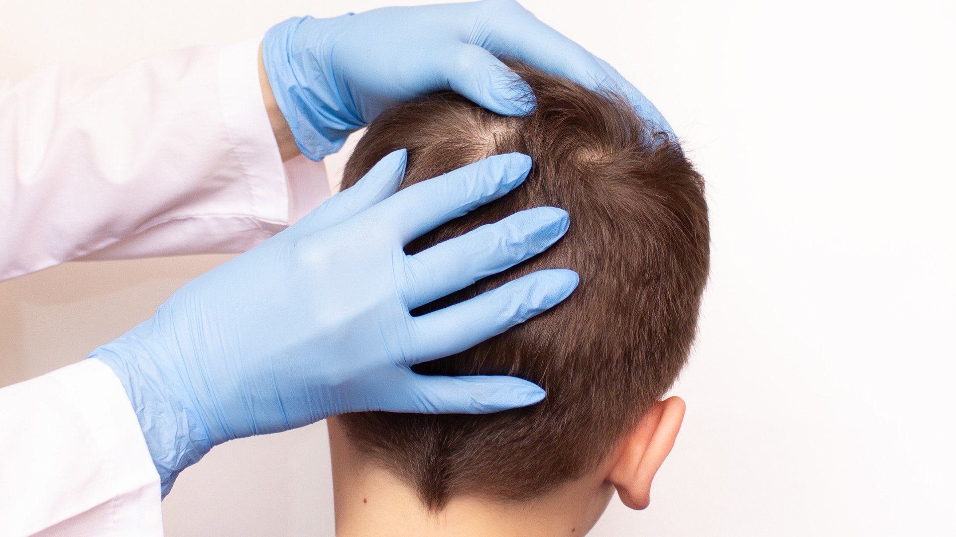 Gloved clinician parts a child's hair near the crown to check the scalp for head lice and feeding bites.