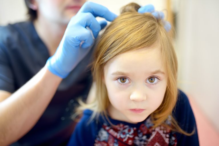 Why Are You Spotting Nits But No Crawling Lice?