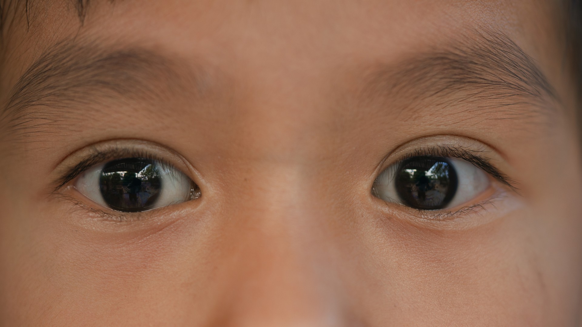 Can Head Lice Live in Eyebrows or Eyelashes?