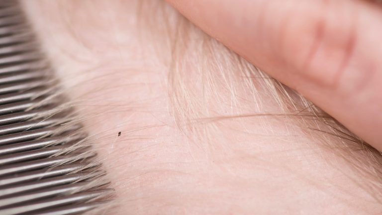 Can Kids With Short Hair Still Get Head Lice?