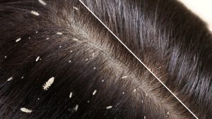 How Contagious Is Head Lice After Exposure?