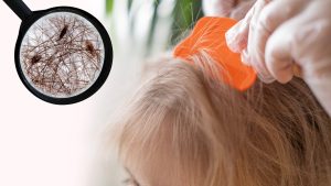 What Are the First Signs You Actually Have Head Lice?