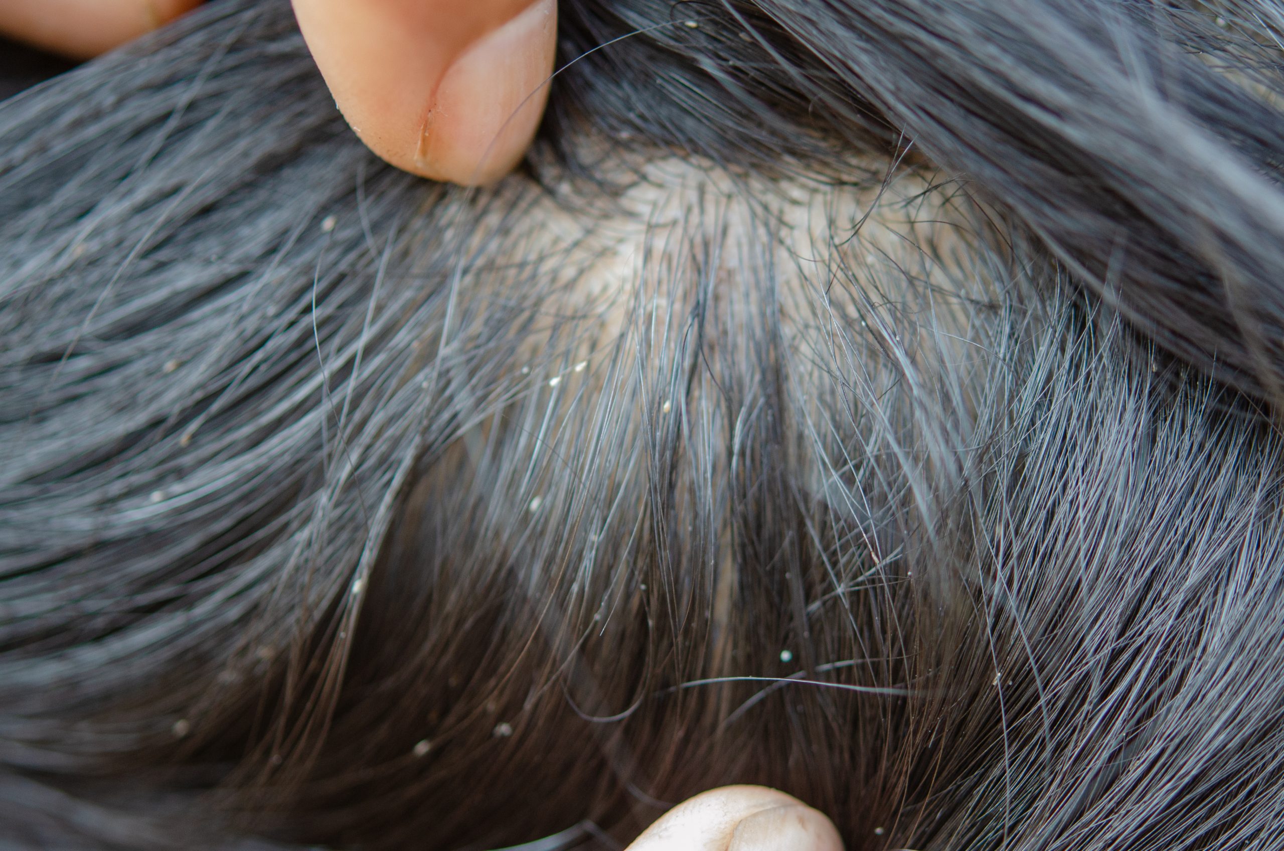 Close-up louse egg on a hair strand