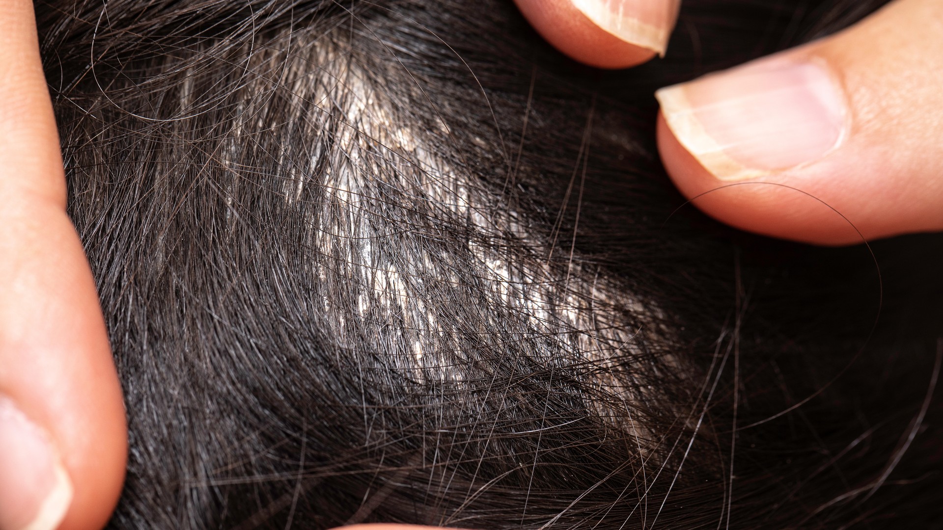 A parent separates and parts a child's hair to check the scalp for head lice during an early at-home head check