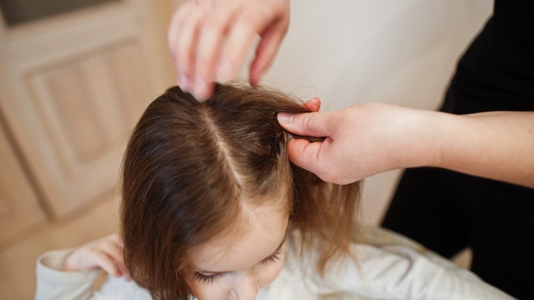 Check the Scalp Before Blaming the Beach for Lice