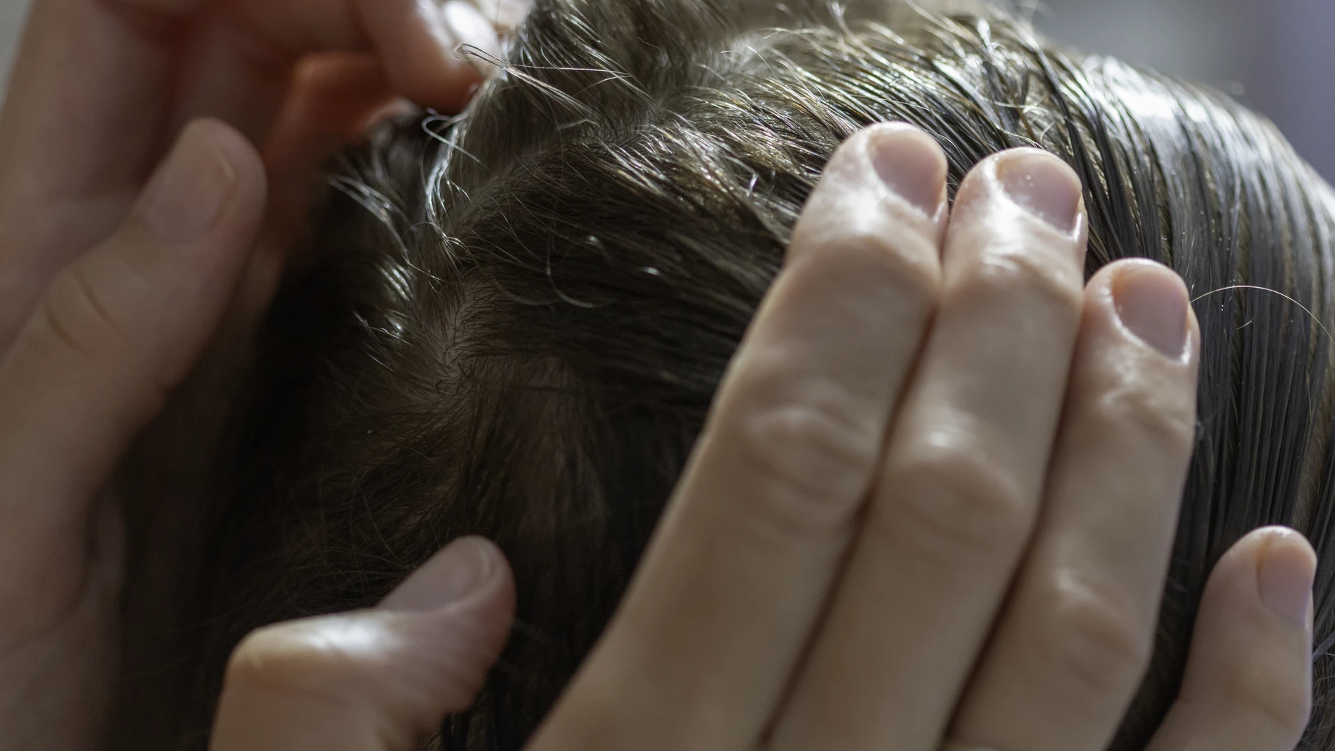 Hands holding dark hair apart to expose the scalp.